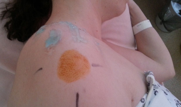 ПРВИ У СВЕТУ: Наши лекари серумом из крви обрисали бол