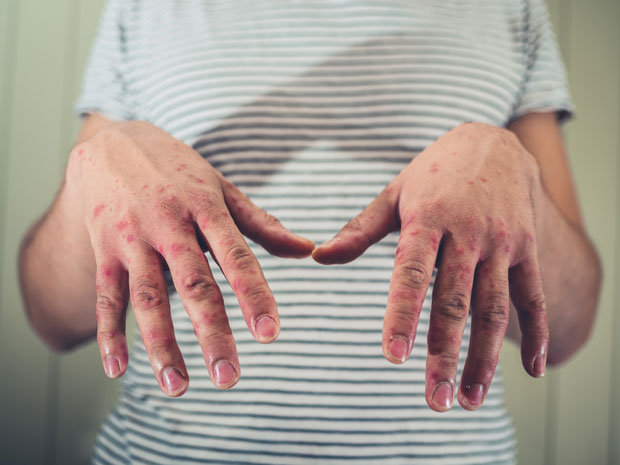 Епидемије морбила у Палама и Источном Сарајеву