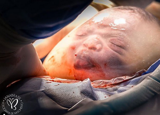 НЕВЕРОВАТАН ПРИЗОР: Рођена “беба у балону” (ФОТО)