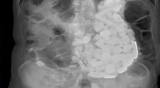 ХИРУРЗИ ЗАПАЊЕНИ: Невероватно шта су све човеку извадили из стомака (ФОТО)