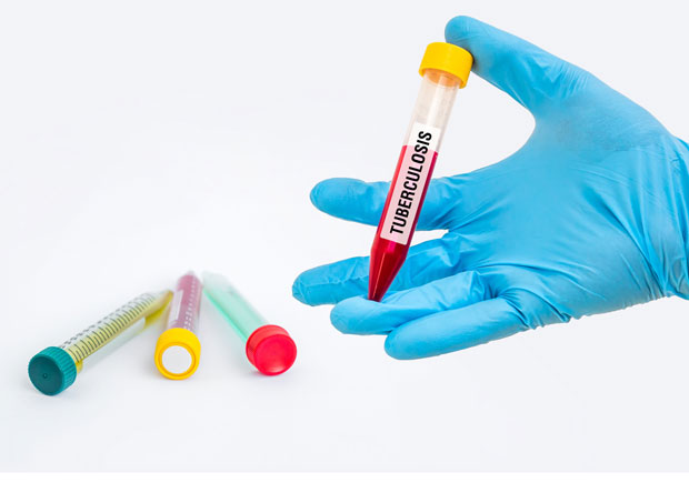 Туберкулоза скоро искорењена