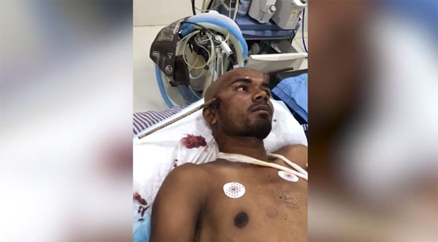 УЗНЕМИРУЈУЋИ СНИМАК: Раднику арматура прошла кроз лобању, свестан чекао да га оперишу 