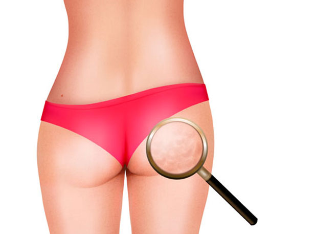 Време је да кренете у борбу против целулита