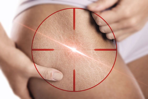 Стрије не могу сасвим да ишчезну