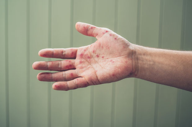 Два радника РТЛ у Загребу оболела од богиња, контрола свих запослених