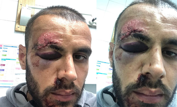 УЗНЕМИРУЈУЋЕ ФОТОГРАФИЈЕ: Македонски фудбалер брутално претучен у Хрватској, напали га штанглом и направили језиве ране на глави