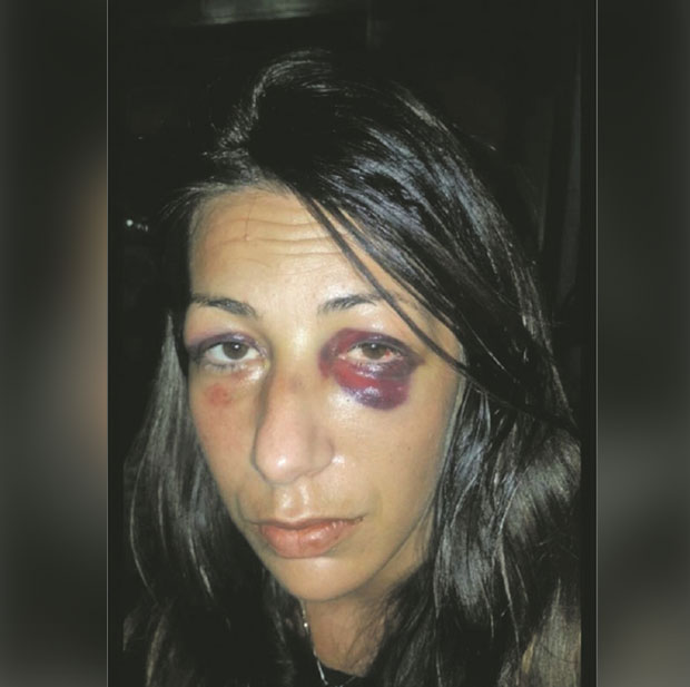 Батине нису љубав! Ова фотографија је за наук свим женама! Жртва породичног насиља проговорила о ономе о чему други упорно ћуте