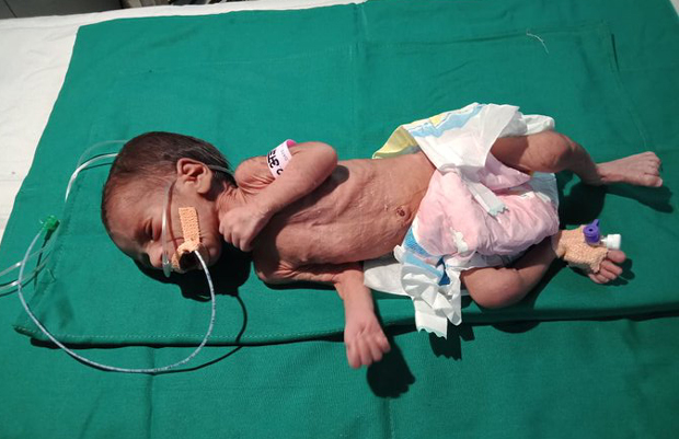 Беба која је ЖИВА ЗАКОПАНА чудом преживела и потпуно се опоравила, лекар објаснио шта је спасило (ВИДЕО)