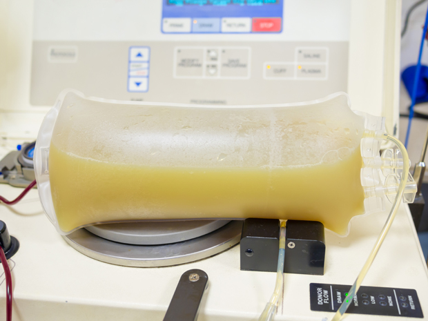 Мушкарац дошао хитно у болицу јер му је крв била бела као млеко, два пута је запушио машину за чишћење крви