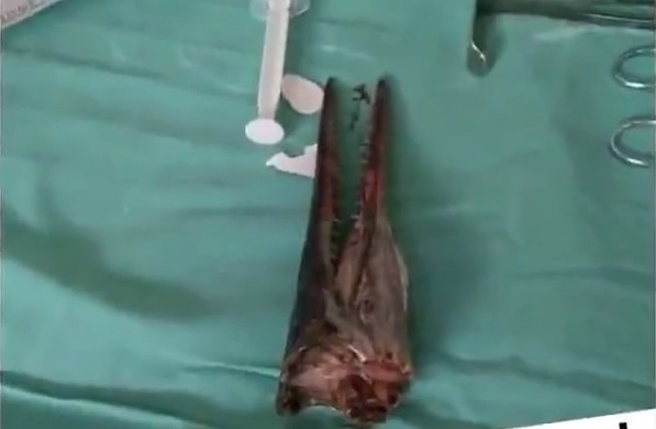 Дечака риба пробола КРОЗ врат и остала ту, НЕВЕРОВАТНО како је стигао кући (УЗНЕМИРУЈУЋЕ ФОТОГРАФИЈЕ)