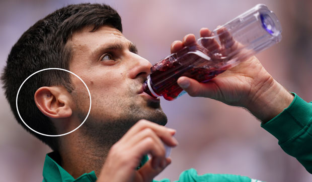 Мистерија црне тачке у Новаковом уву: Да ли Ђоковић користи древну кинеску технику?