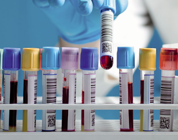 Проверите мокраћну киселину: Њен ниво у крви значајан je показатељ здравља, a посебно код ових пацијената