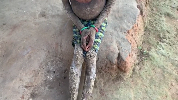 Девојчица се полако претвара у камен: Ову неизлечиву болест имају само 24 особе на свету (ВИДЕО)