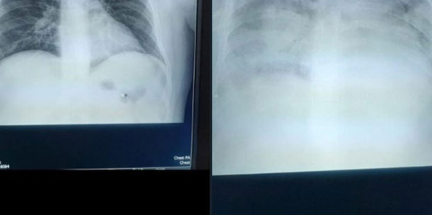 Пријаве против крагујевачког хирурга због објављивања снимака плућа преминулог пацијента