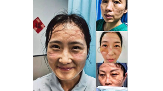 Ожиљци хероја: Погледајте како изгледају кинески лекари након скидања маски и победе над короном (ФОТО)