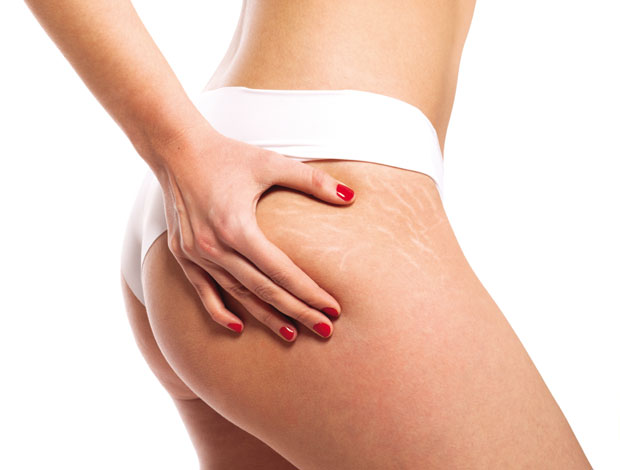 Појавиле су вам се стрије? Немојте очајавати, овај природни мелем ће вам помоћи да их се решите