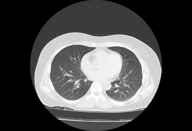 Лекари широм света БРУЈЕ о случају младе жене: Није имала ниједан симптом короне,а онда је снимак плућа ПОКАЗАО ОВО и хоспитализована је