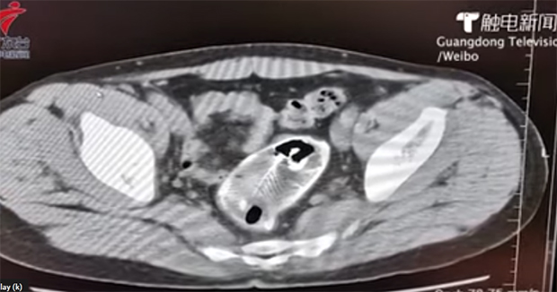 Веровали или не?  Мушкарцу извадили мртву рибу из ануса, хирурзима позлило током операције (ВИДЕО)