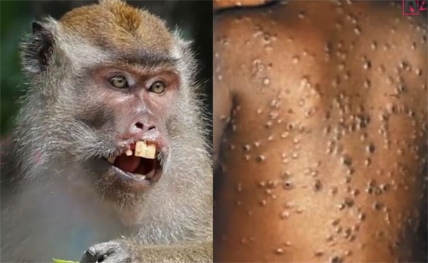 ИНСТИТУТ: Мале шансе да у Црну Гору стигне мајмунска грозница